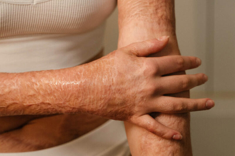 Burns Scars | Brisbane Skin, Dermatologist Brisbane. Medical, surgical,  cosmetic
