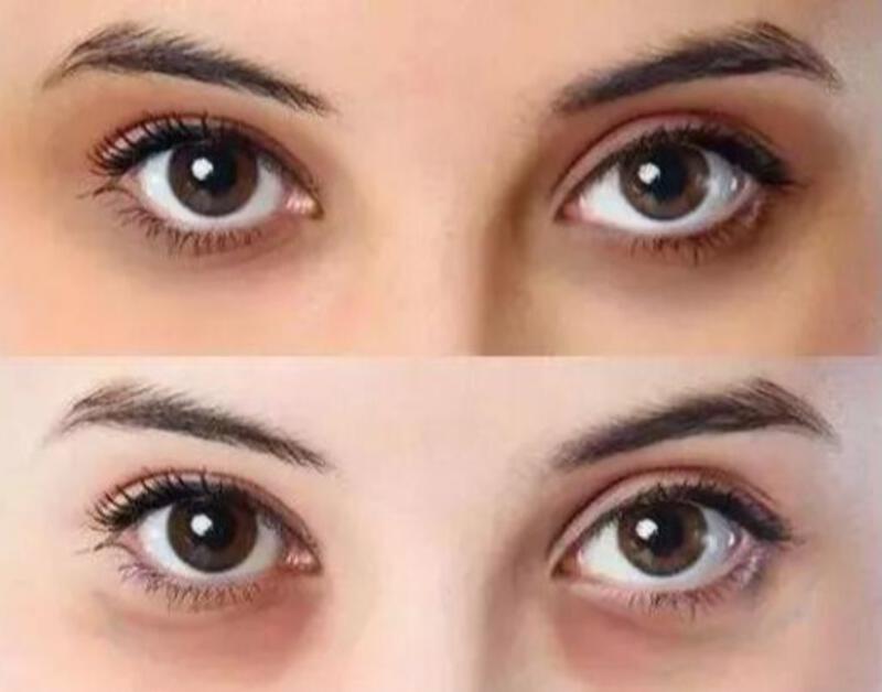 如何自我分辨黑眼圈类型？ - 知乎